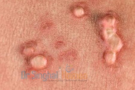 Best Homeopathic Doctor for HPV & Genital Warts Treatment