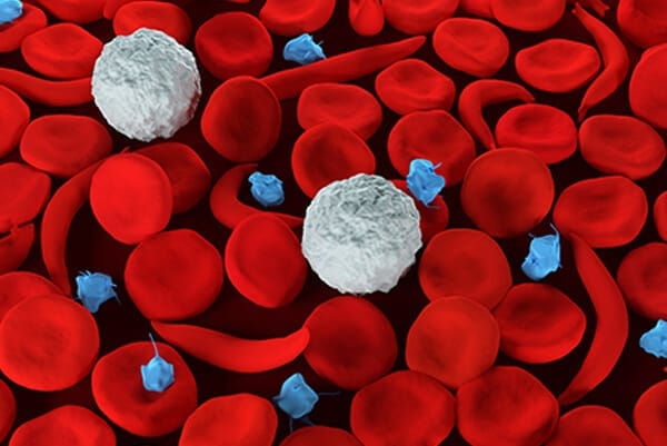 Aplastic Anemia Treatment in Homeopathy— Natural & Effective