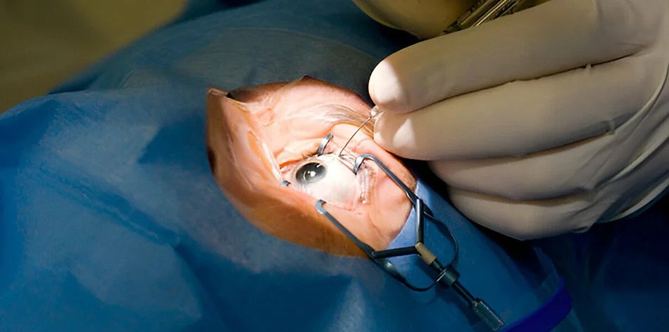 Best Cataract Surgery Cost in Delhi