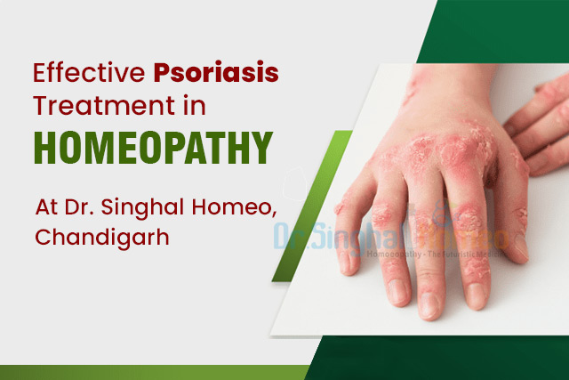 Homeopathic Medicines for Psoriasis Treatment: A Natural Approach to Skin Health – health