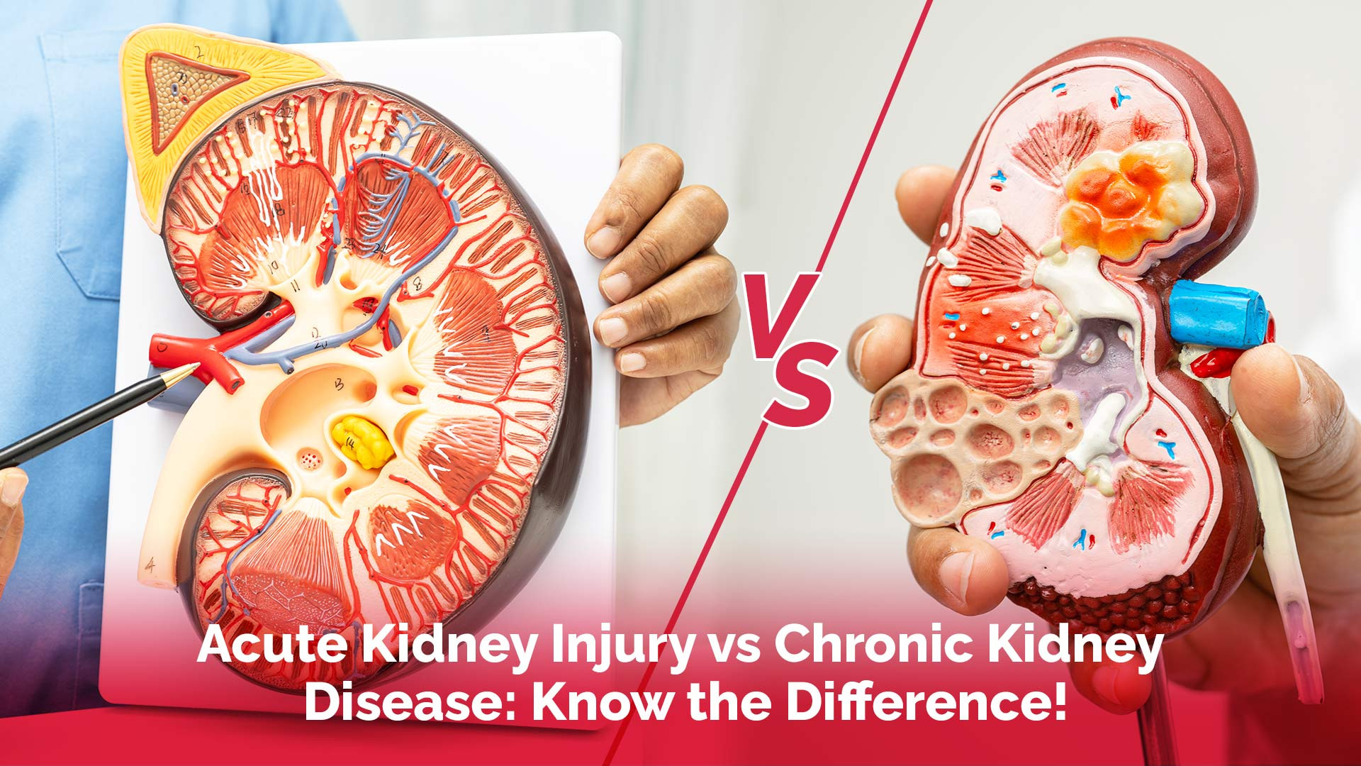 Know Where You Stand: Acute Kidney Injury vs Chronic Kidney Disease