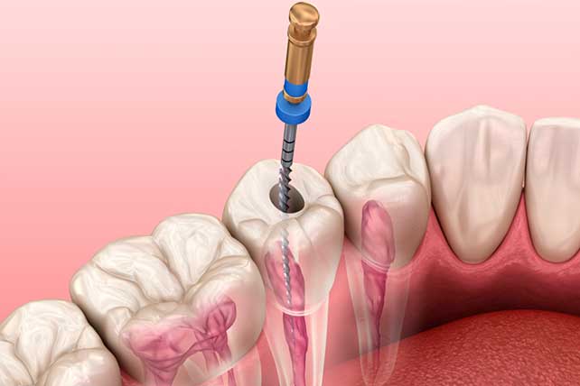 Endodoncia en Chile - Clínica Dental Cristian Lagos