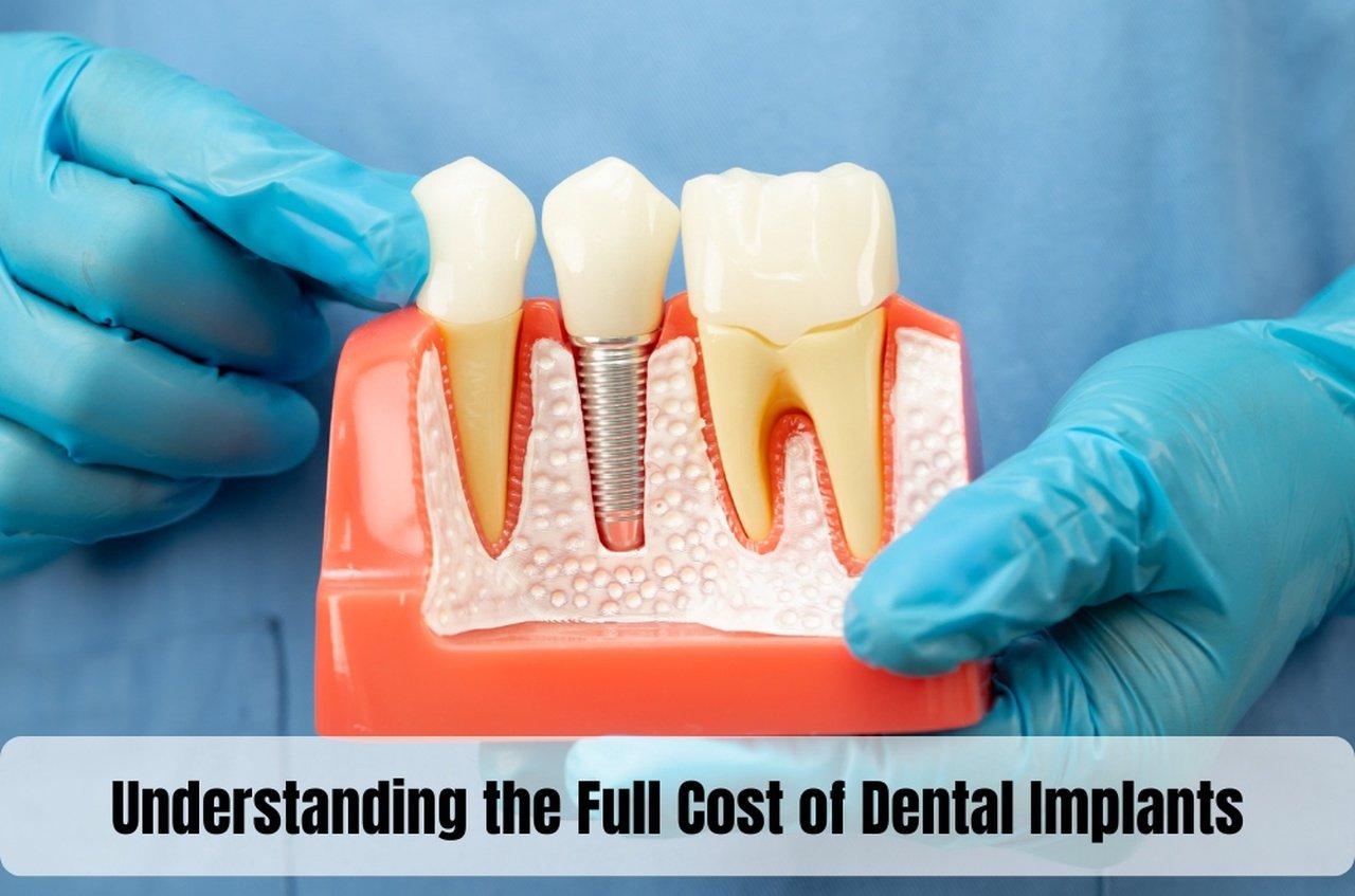 Understanding the Full Cost of Dental Implants | Articles | Barbara Honey | Gan Jing World - Technology for Humanity | Video & Movie Streaming