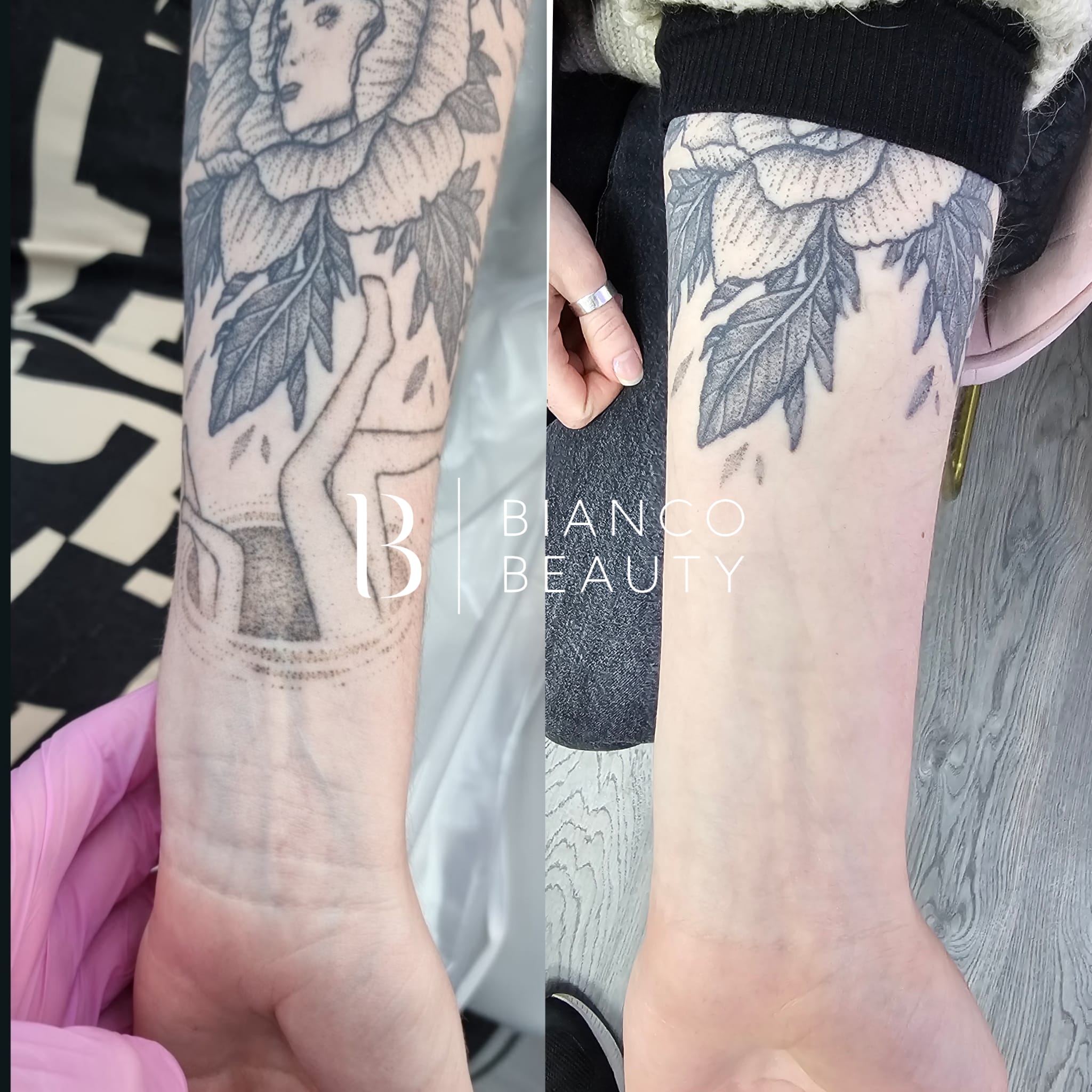 Laser Tattoo Removal & SPMU Removal Clinic | Bianco Beauty