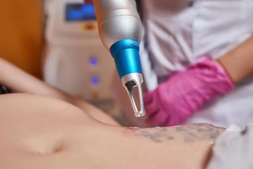 Tattoo Remains After Removal: Causes and Prevention Tips
