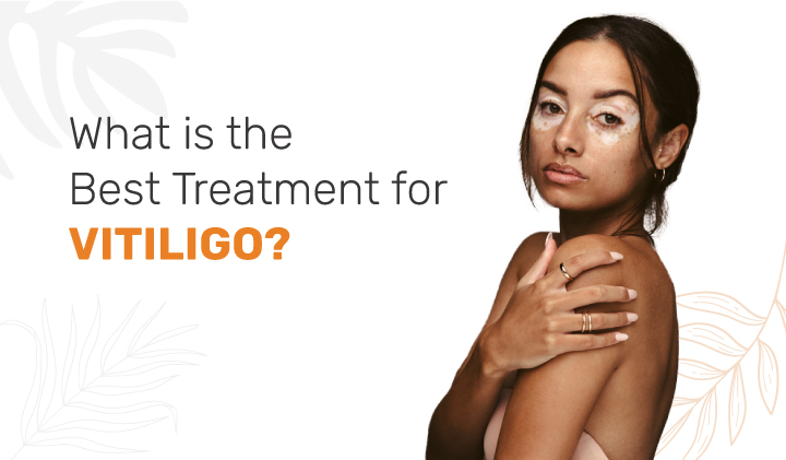 Vitiligo Treatment in Ahmedabad | Advanced Skin Care Solutions