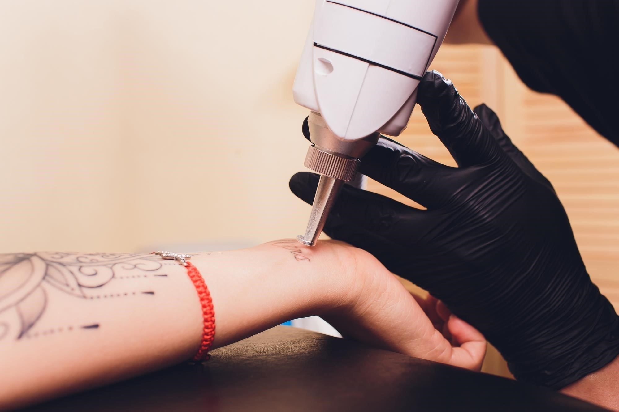 Why Manchester People Choose Picosecond Laser Tattoo Removal