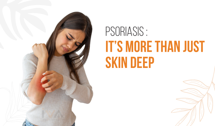 Best Psoriasis Treatment in Ahmedabad