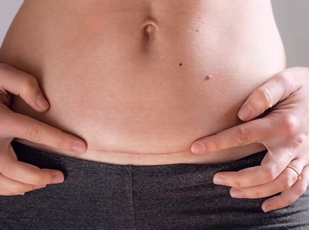 C-Section Scar Massage for New Moms in Parkland, FL