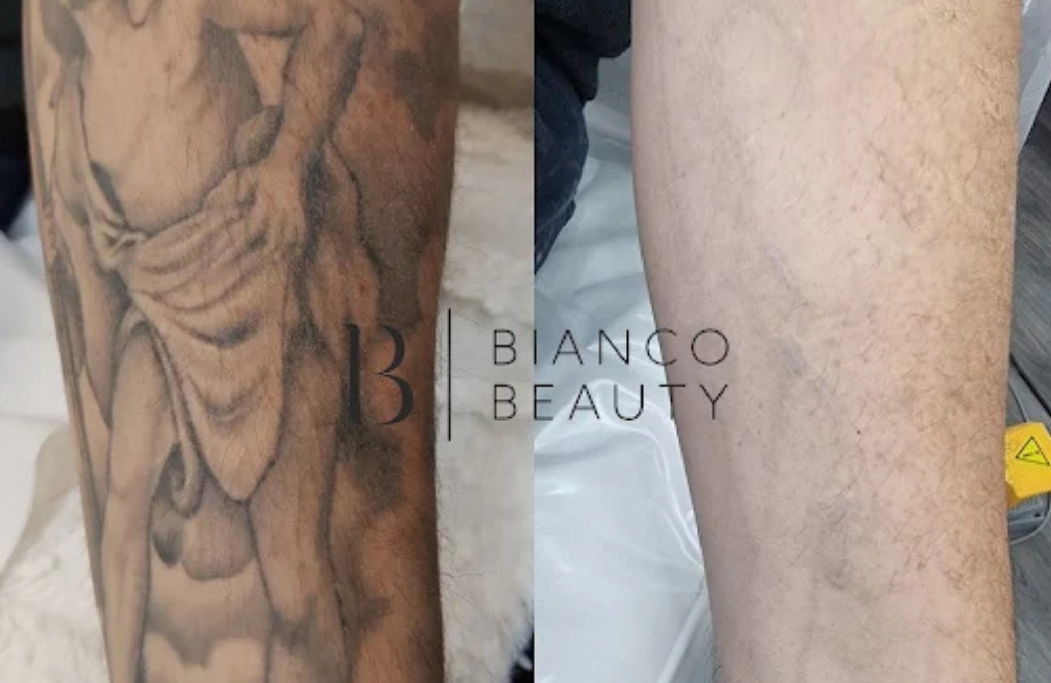 How Much Does Tattoo Removal Cost in the UK | Full Guide