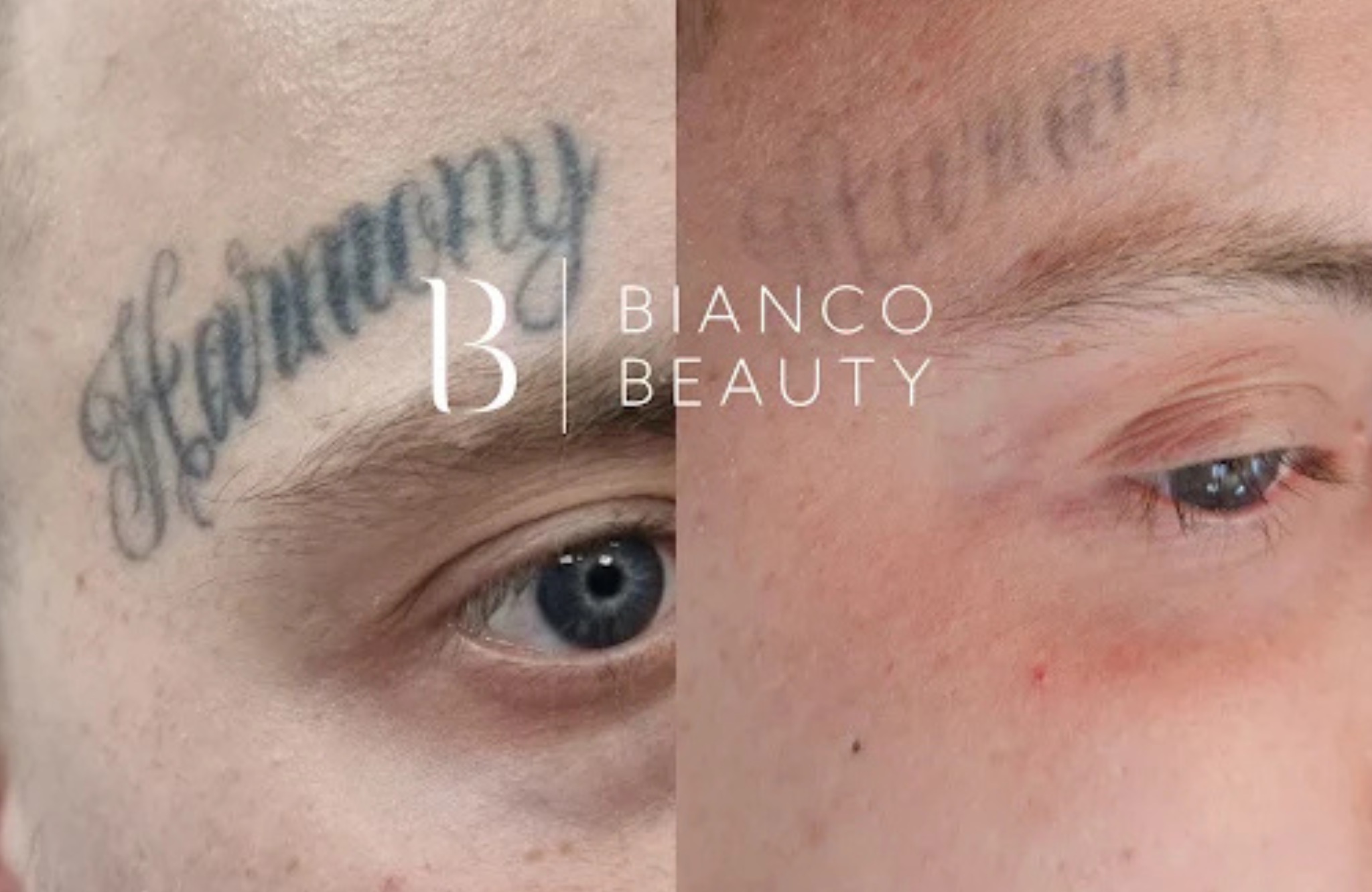 Facial Tattoo Removal: Safety, Sessions and Results